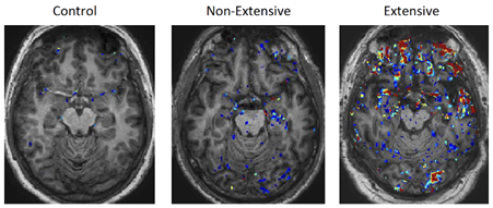 A comparison of the MRI brain scans of people in different cohorts